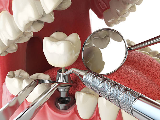 Best Emergency Dental Services for Seniors in Mountain View, CA
